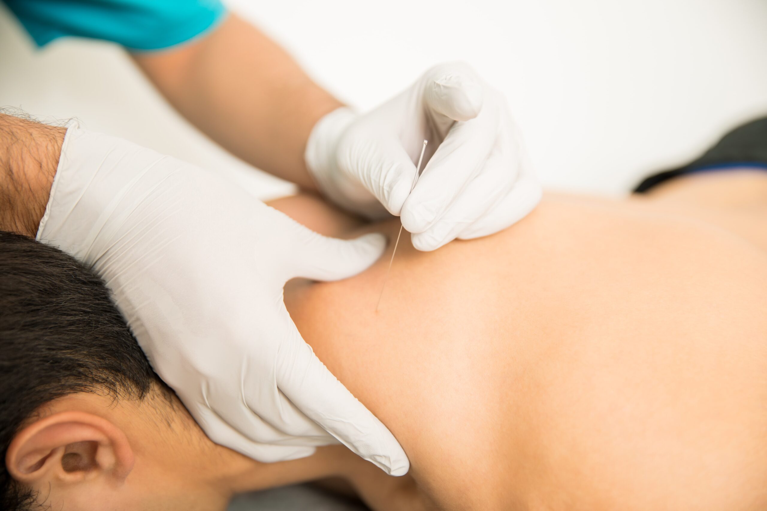 closeup-shirtless-man-receiving-dry-needling-therapy-from-doctor-clinic-min spa-day-for-men